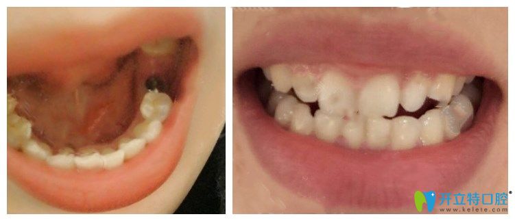 漯河舒適美口腔許克哲種植牙案例 漯河舒適美口腔許克哲種植牙案例