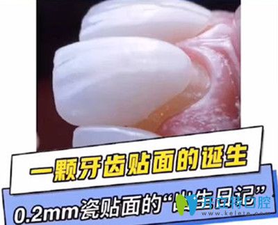 如果瓷貼面做了后悔死了，趕緊來了解德國冰瓷牙貼面