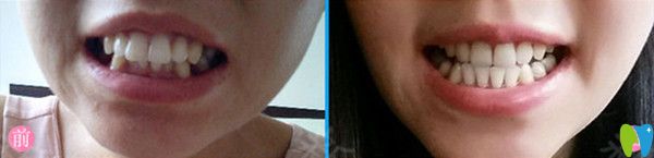 牙齒矯正前后對(duì)比圖