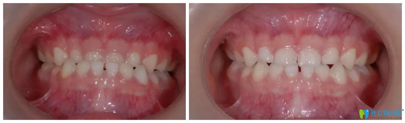 推簧矯正器矯正地包天前后對比圖