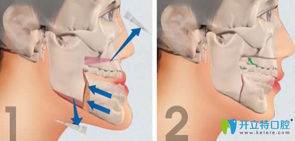 正畸正頜聯(lián)合治療費用貴高嗎