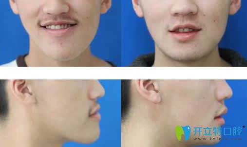 反頜正畸正頜聯(lián)合治療前后對比照片