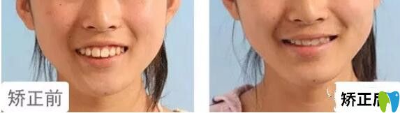 格倫菲爾口腔水平如何？14女孩上牙前突矯正<span style=