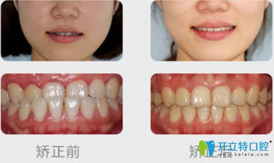 維樂(lè)口腔王燕燕青少年地包天矯正案例效果