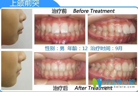 深圳格倫菲爾口腔好嗎？12歲男孩齙牙矯正<span style=