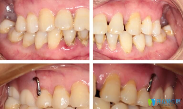 維他靈支架真實(shí)病例對(duì)比