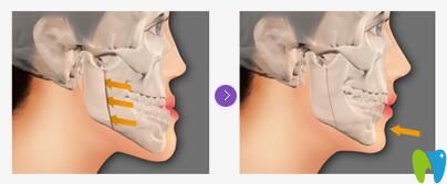 兜齒和地包天的區(qū)別 兜齒和地包天的區(qū)別