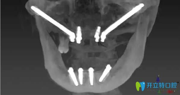 南京博韻口腔穿顴骨種植技術(shù)