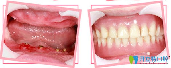 全口種植修復(fù)