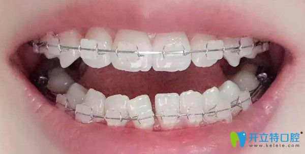 帶牙套1~12月變化圖