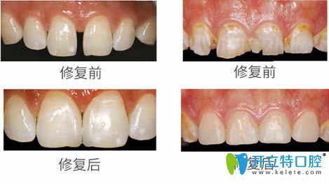 武漢清華陽光王培醫(yī)生前牙美學(xué)修復(fù)案例效果