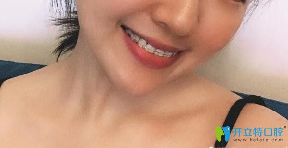 牙齒矯正調(diào)整咬合和收縫的階段