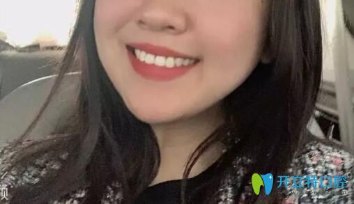 杭州艾芳口腔卸牙套后照片