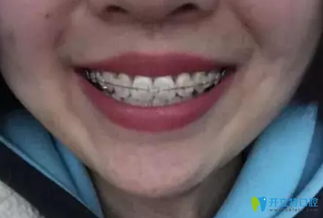 杭州艾芳口腔牙齒矯正排齊過(guò)程