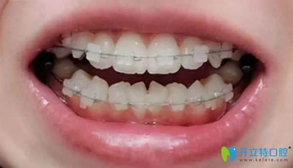 矯正第2個(gè)月上牙照片