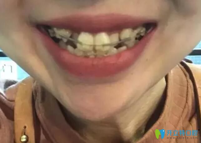 艾芳口腔牙齒矯正上彈簧