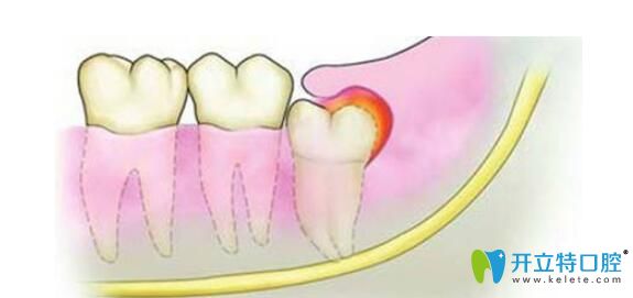 盡頭牙發(fā)炎該怎么辦