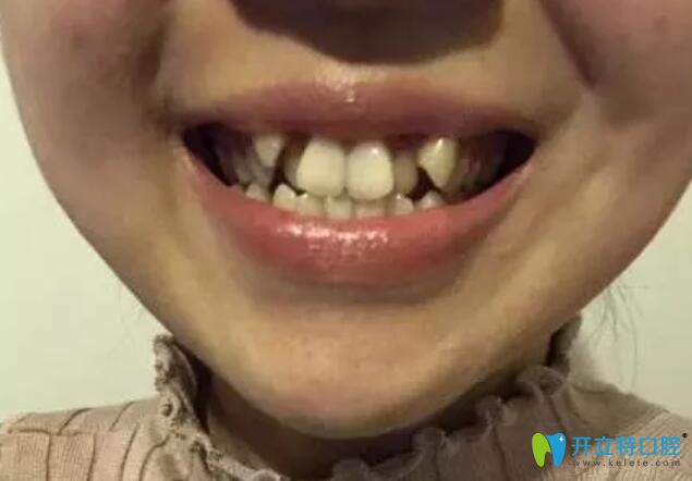 在杭州艾芳口腔矯正牙齒，我拔過牙加過彈簧還上過橡皮筋