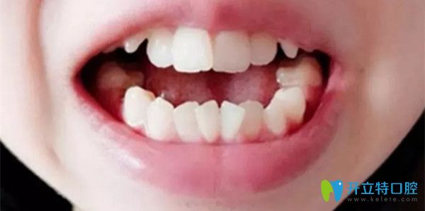 牙齒矯正前的照片