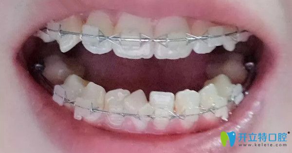 正畸8個(gè)月時(shí)的樣子