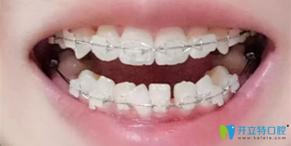 牙齒矯正半年后的效果圖