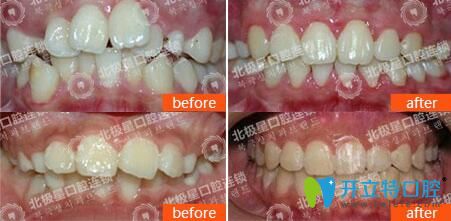 泰州北極星口腔薛迎春主任隱形矯正案例 泰州北極星口腔薛迎春主任隱形矯正案例