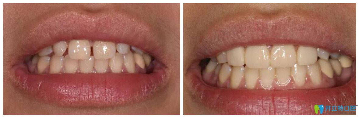 好佰年口腔楊素牙貼面修復(fù)牙齒縫隙過大、過小牙案例