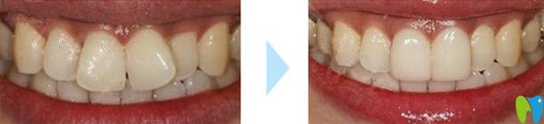 前牙美容冠修復(fù)比對圖