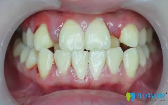 在南陽康澤口腔矯正前的牙齒照片 在南陽康澤口腔矯正前的牙齒照片