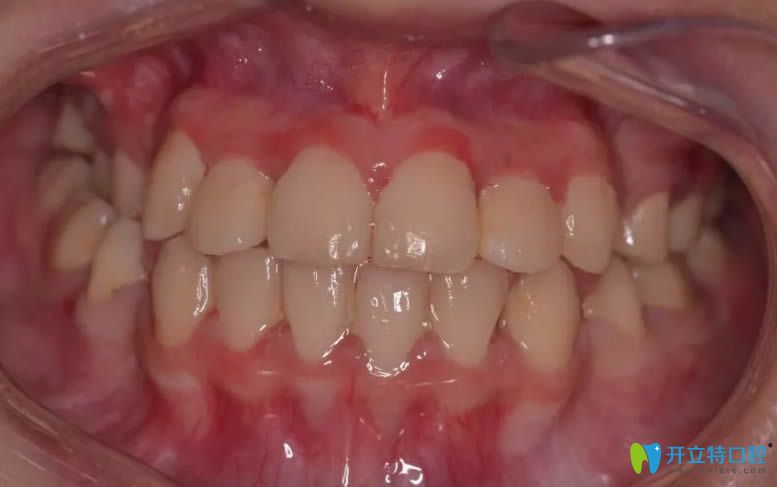 我在南陽康澤口腔牙齒矯正后的效果圖 我在南陽康澤口腔牙齒矯正后的效果圖