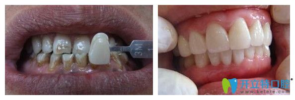 牙齒煙斑貼面效果圖