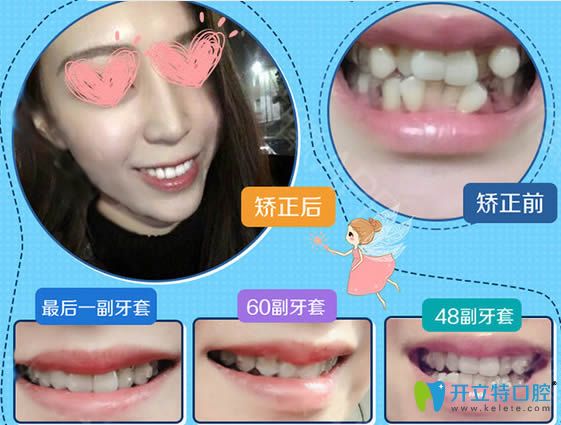 西安壹加壹牙科成人牙齒擁擠矯正前后對比照