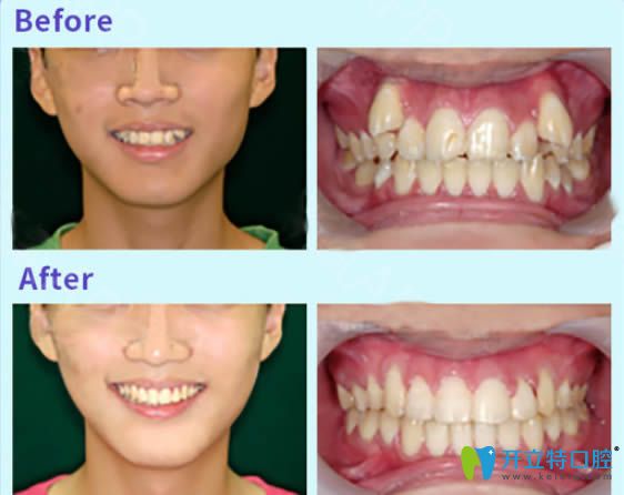 壹加壹口腔青少年虎牙矯正前后對比效果