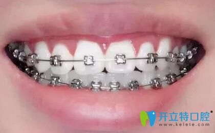 我在重慶鵬博口腔做牙齒矯正16個(gè)月 我在重慶鵬博口腔做牙齒矯正16個(gè)月