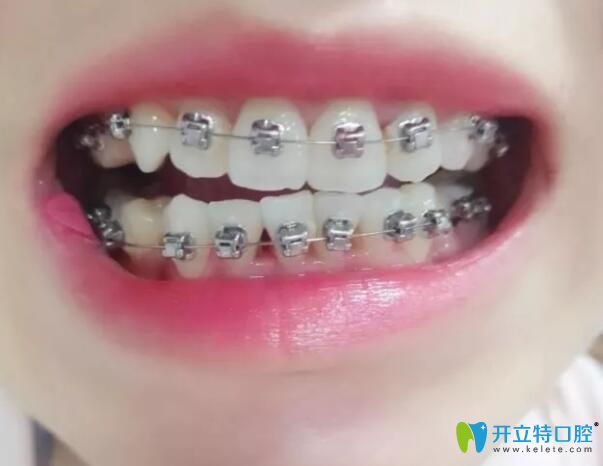 江會昇牙齒矯正1個月變化圖