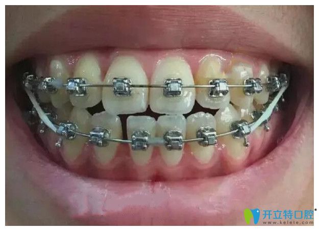 我在鵬博口腔做牙齒矯正第10個(gè)月 我在鵬博口腔做牙齒矯正第10個(gè)月