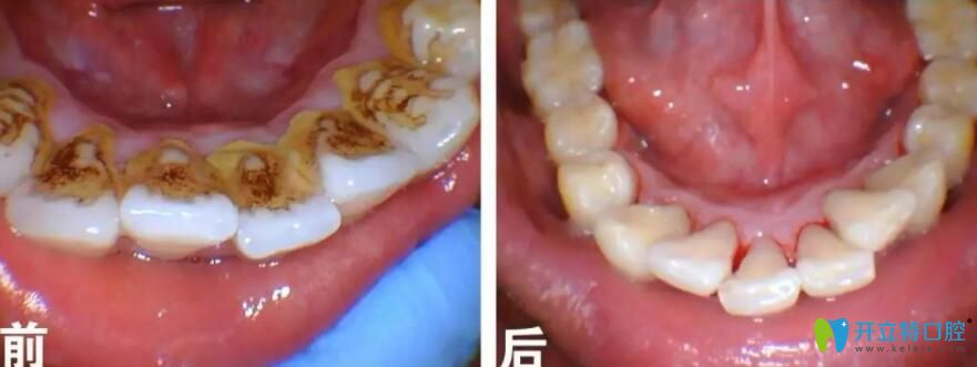 牙齒煙斑冷光美白前后對(duì)比圖
