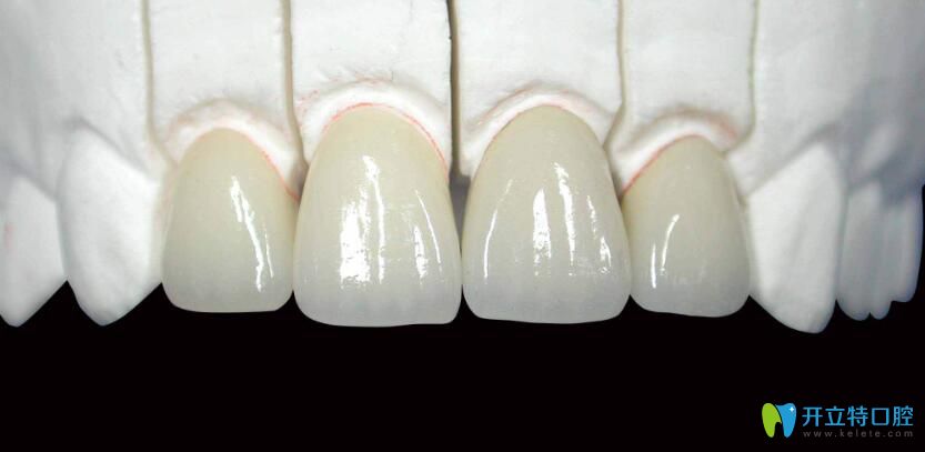 什么是烤瓷牙?烤瓷牙的危害有哪些？中山禾佳口腔醫(yī)生講解