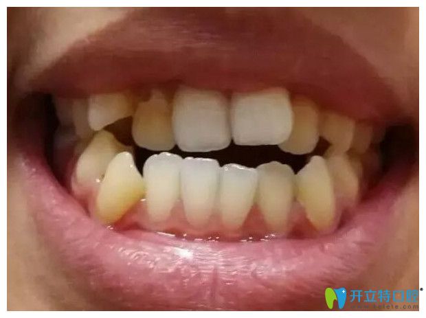 在重慶鵬博口腔做牙齒矯正經(jīng)歷雖辛苦,但是沒有牙套臉