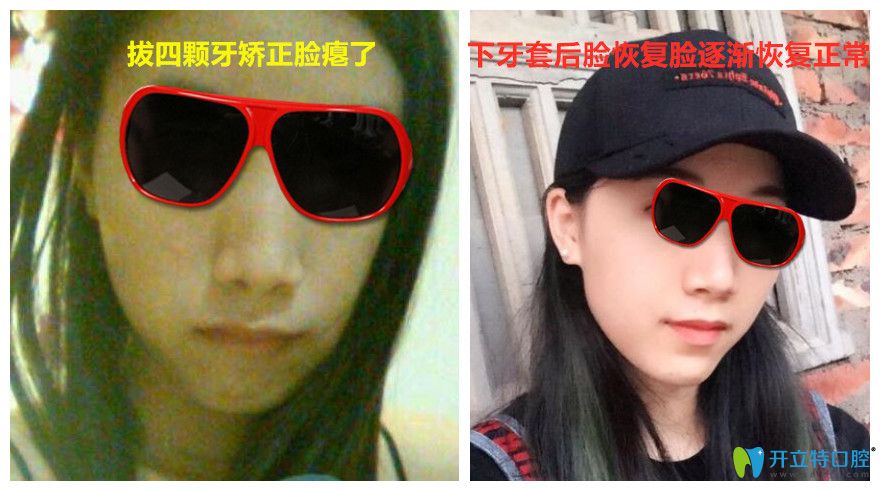 正畸過程拔牙后臉癟卸掉牙套后情況會好
