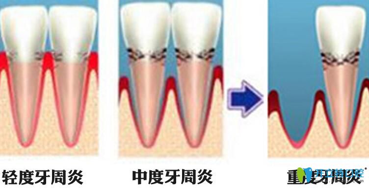 牙周炎圖片 牙周炎圖片