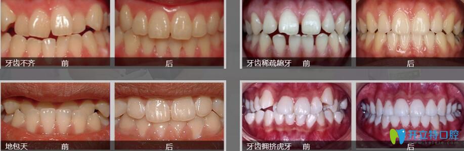 東莞好佰年正畸怎么樣？張子捷幾例子牙齒矯正案例效果對(duì)比圖來(lái)說(shuō)明