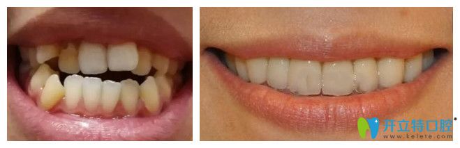 重慶鵬博口腔隱形牙齒矯正效果圖 重慶鵬博口腔隱形牙齒矯正效果圖