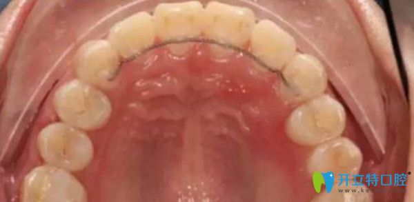 舌側(cè)保持器，它的優(yōu)缺點(diǎn)及佩戴時(shí)間你造嗎