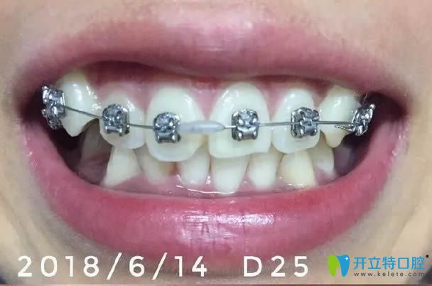 戴自鎖牙套2個月的照片 戴自鎖牙套2個月的照片