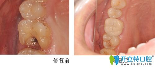 泰州北極星口腔段杰華主任根管治療案例
