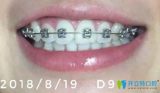 戴牙套已經(jīng)4個月了 戴牙套已經(jīng)4個月了