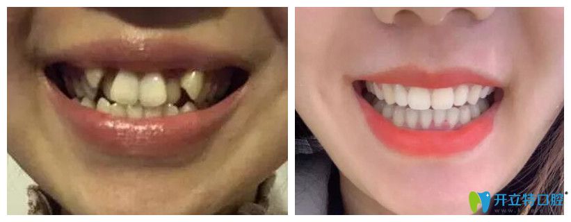 重慶鵬博口腔王鵬院長牙齒隱形矯正案例 重慶鵬博口腔王鵬院長牙齒隱形矯正案例