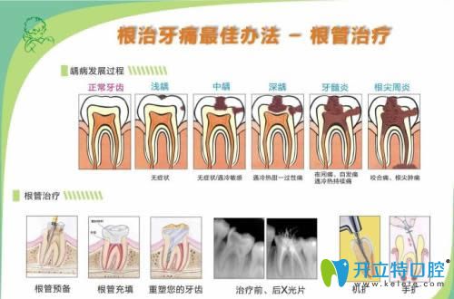 兒童乳牙根管治療步驟由廈門康德佳口腔進(jìn)行科普