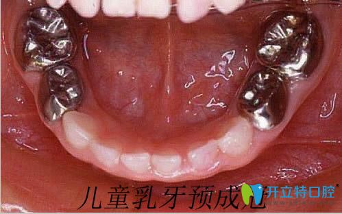 兒童乳牙根管治療后的預成冠 兒童乳牙根管治療后的預成冠